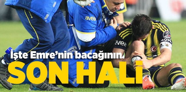 Emre'nin bacağı bu hale geldi
