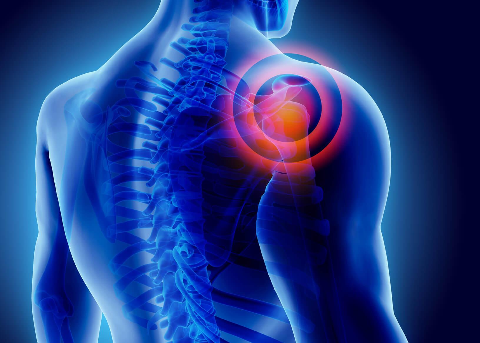 Omuz ağrısı nasıl geçer? Sağ ve sol omuz ağrısı neden olur ve ne iyi